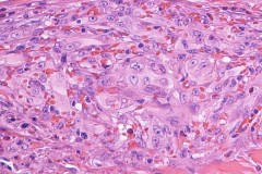 Epithelioid angiosarcoma