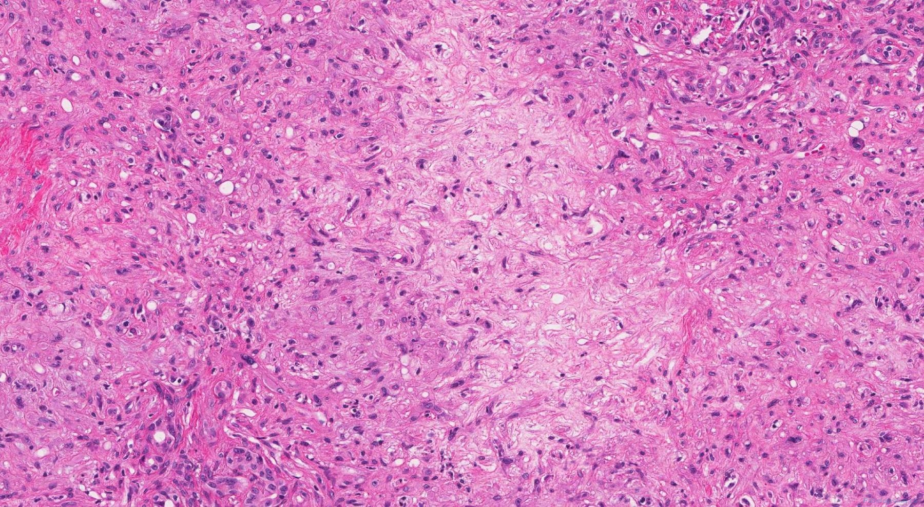 Epithelioid hemangioendothelioma of the liver | Atlas of Pathology