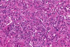 Epithelioid hemangioendothelioma of the liver