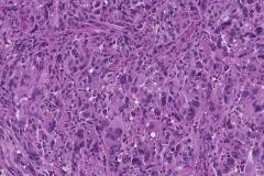 Epithelioid malignant peripheral nerve sheath tumour