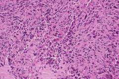 Epithelioid malignant peripheral nerve sheath tumour