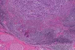 Epithelioid malignant peripheral nerve sheath tumour