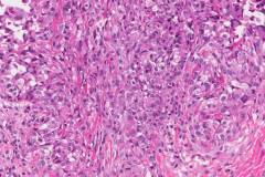 Epithelioid sarcoma