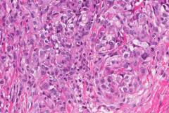 Epithelioid sarcoma