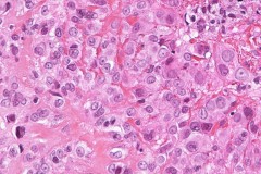 Epithelioid sarcoma