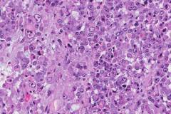 Epithelioid sarcoma