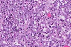 Epithelioid sarcoma