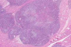 Epithelioid sarcoma