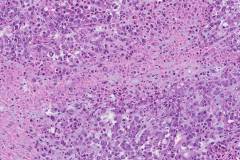 Epithelioid sarcoma