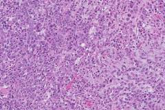 Epithelioid sarcoma