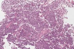 Ewings sarcoma