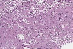 Pseudodecidualization of the endometrium