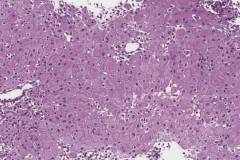 Pseudodecidualization of the endometrium