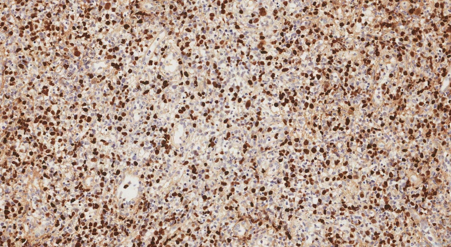 Extranodal NK/T Cell Lymphoma | Ottawa Atlas Of Pathology