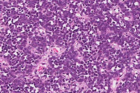 Extraosseous Ewings sarcoma | Ottawa Atlas of Pathology