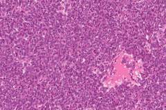 Extraosseous Ewings sarcoma