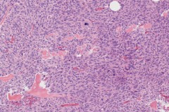 Extraskeletal osteosarcoma