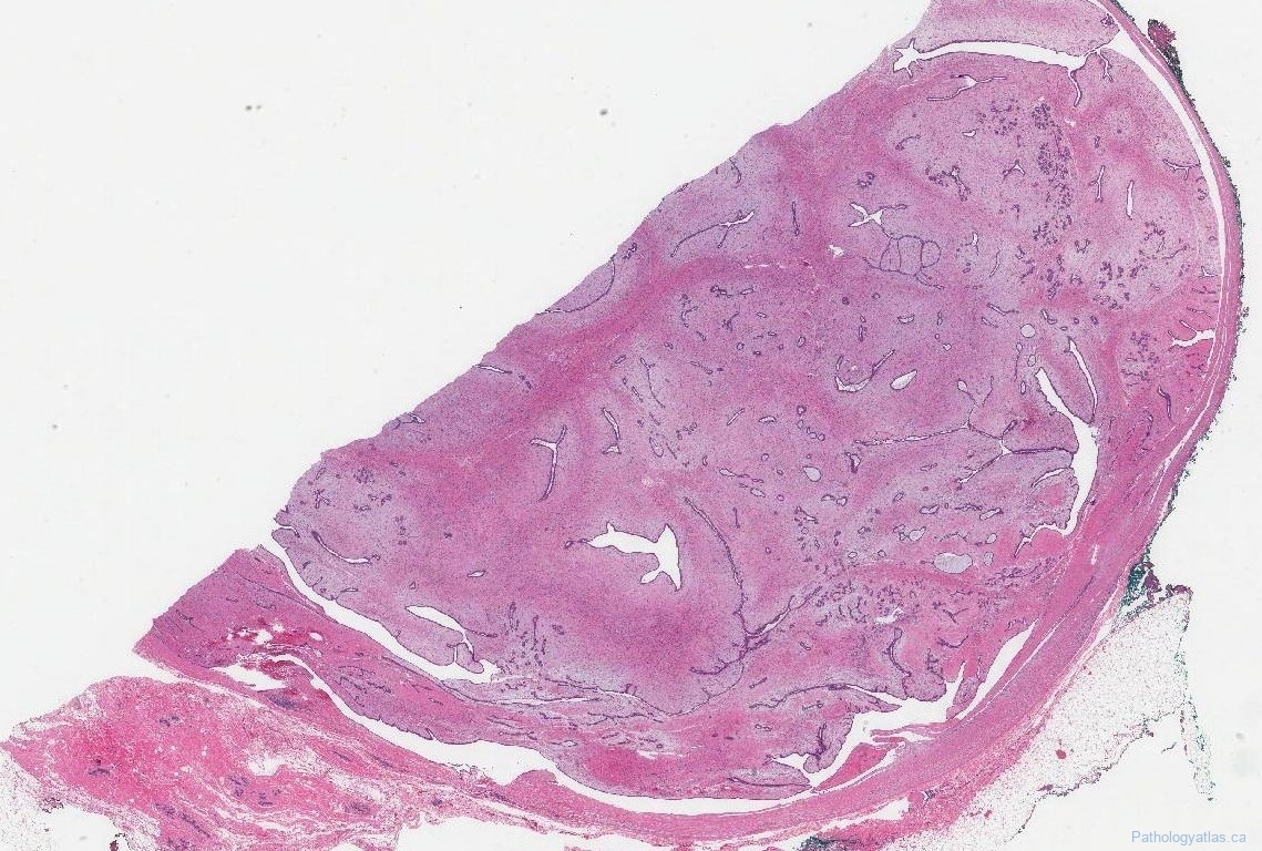 Fibroadenoma | Atlas of Pathology