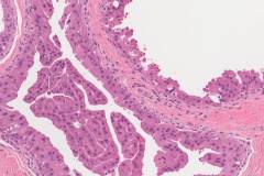 Apocrine metaplasia of the breast