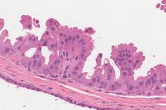 Apocrine metaplasia of the breast