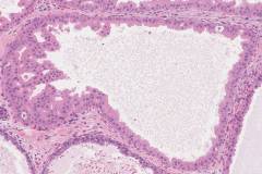 Apocrine metaplasia of the breast