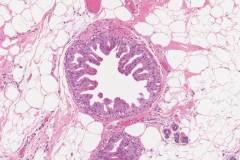 Apocrine metaplasia in the breast