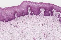 Fibroepithelial polyp of the perianal skin