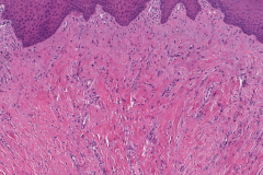 Fibroma of the tongue