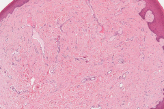 Fibroma of the tongue