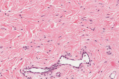 Fibroma of the tongue