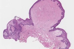 Fibroma of the tongue