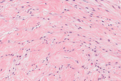 Fibromyxoma