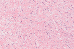 Fibromyxoma