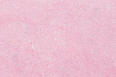 Fibromyxoma