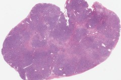 Fibrothecoma of the ovary