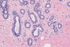 Flat epithelial atypia