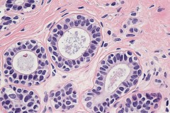 Flat epithelial atypia