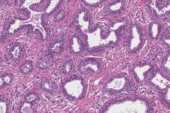 Flat epithelial atypia of the breast