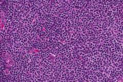 Follicular lymphoma