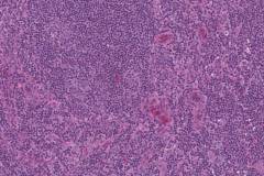 Follicular T cell lymphoma