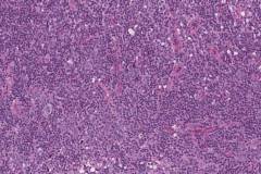 Follicular T cell lymphoma