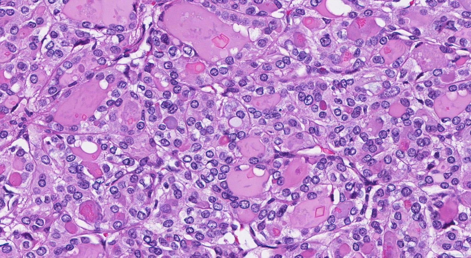 Follicular variant papillary thyroid carcinoma | Atlas of Pathology