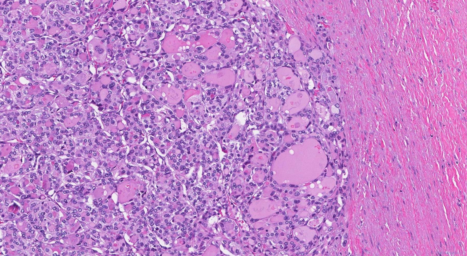 Follicular variant papillary thyroid carcinoma | Atlas of Pathology