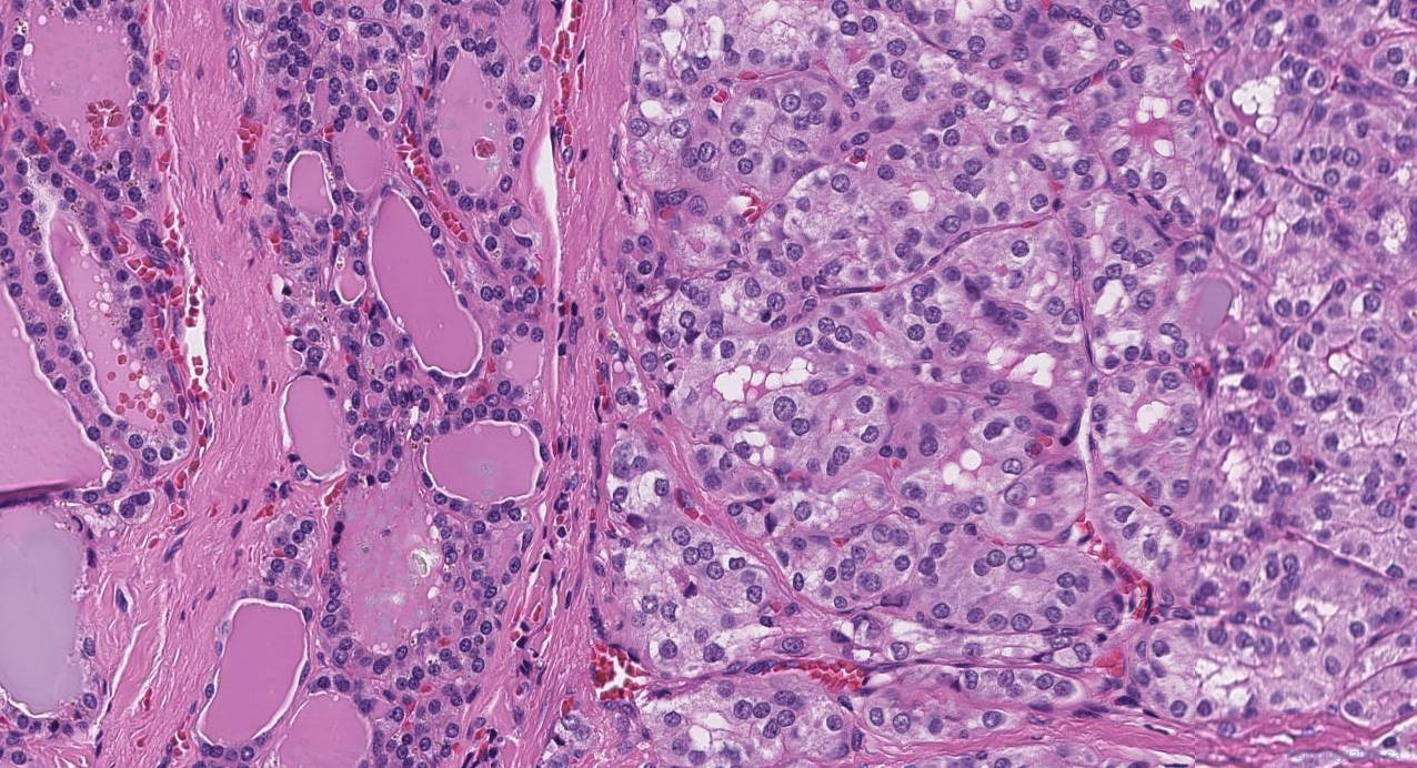 Follicular variant papillary thyroid carcinoma | Atlas of Pathology