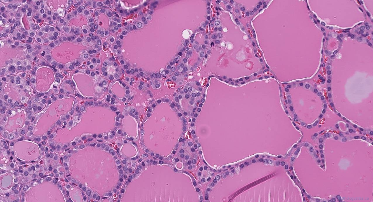 Follicular Variant Papillary Thyroid Carcinoma Atlas Of Pathology