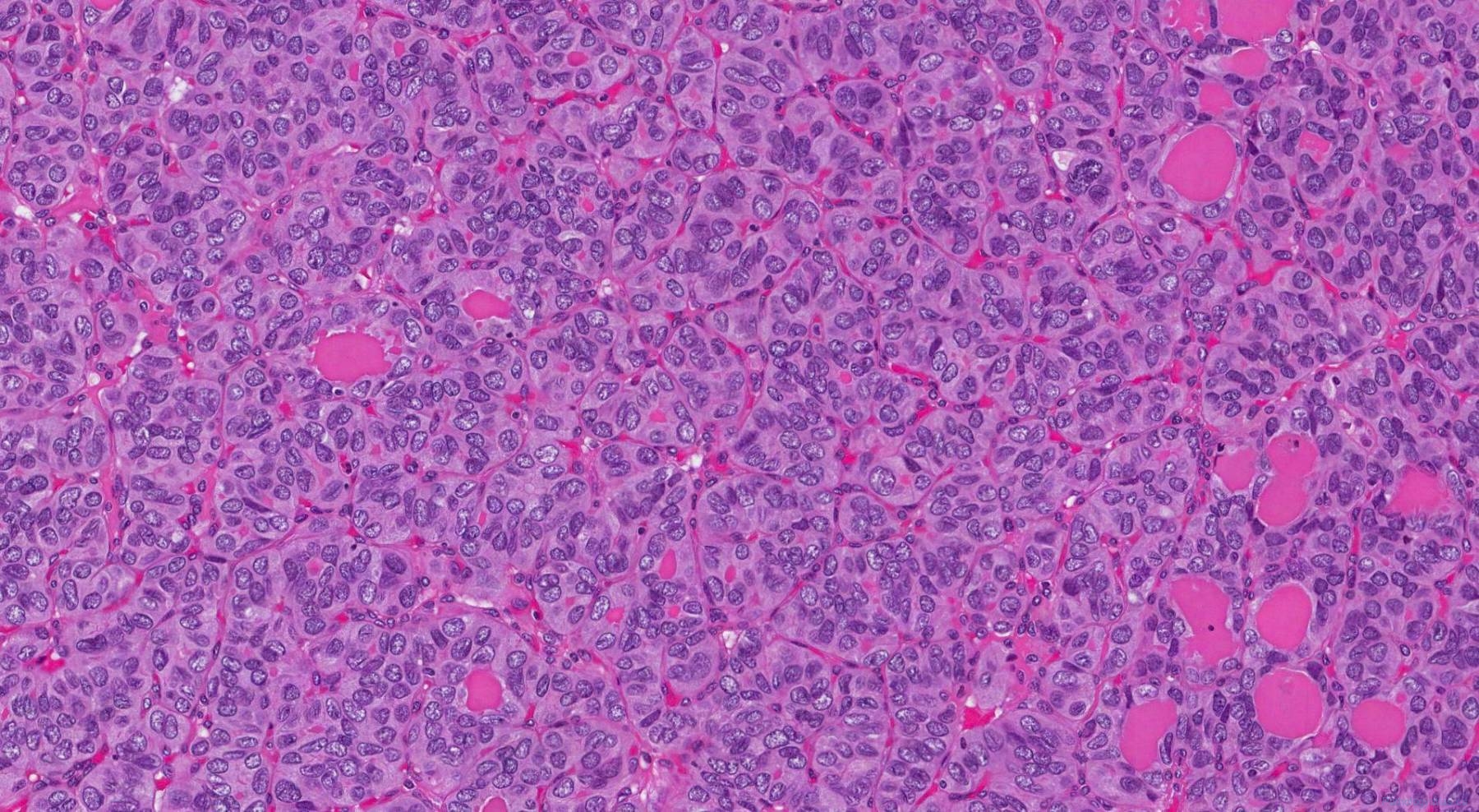 Follicular Variant Papillary Thyroid Carcinoma Atlas Of Pathology