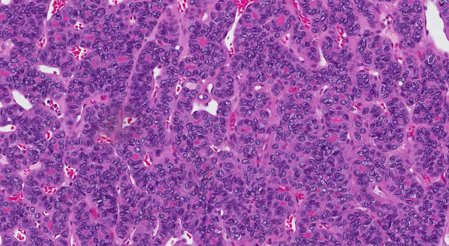 Follicular variant papillary thyroid carcinoma | Atlas of Pathology