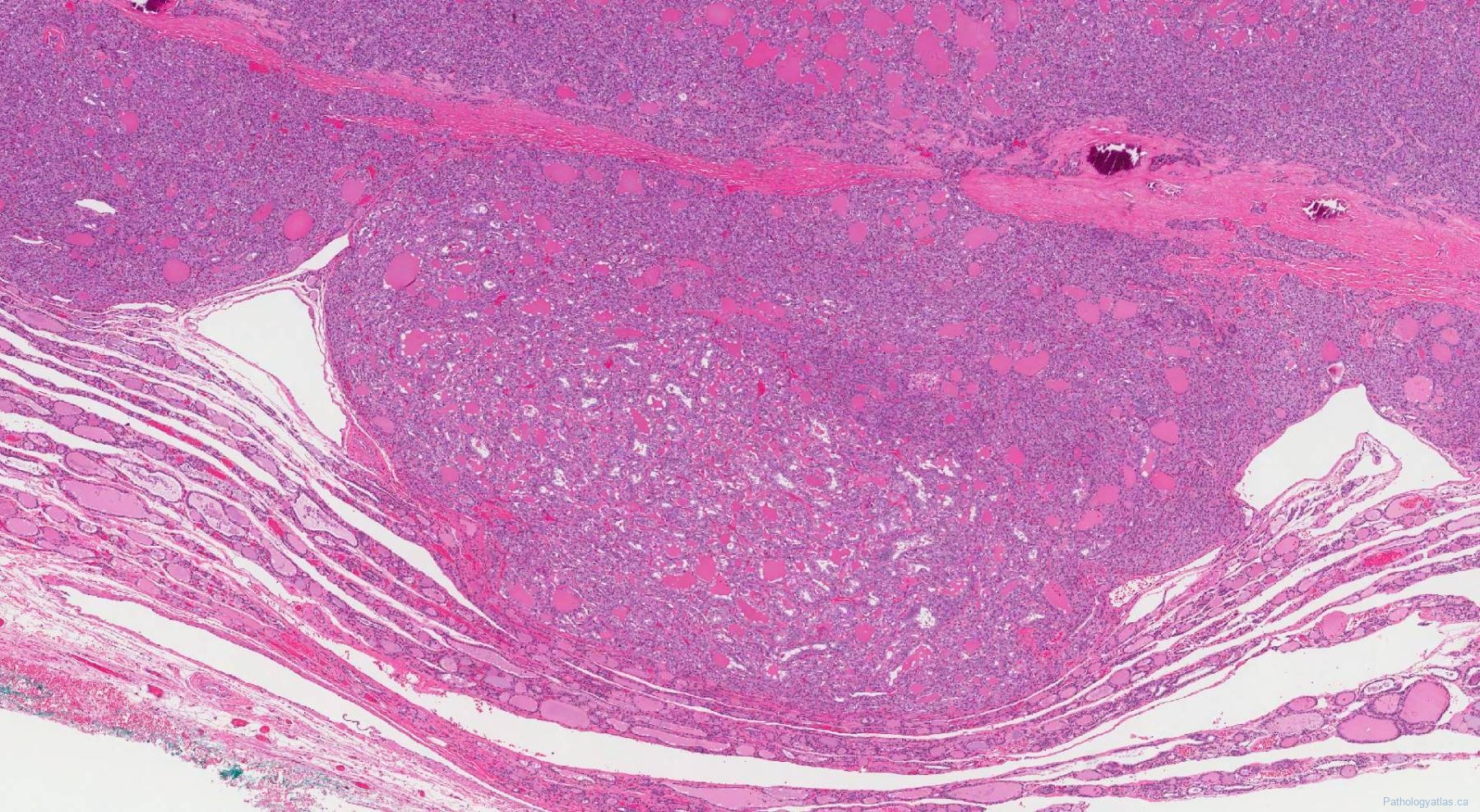 Follicular variant papillary thyroid carcinoma | Atlas of Pathology