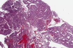 Foveolar adenoma with high grade dysplasia