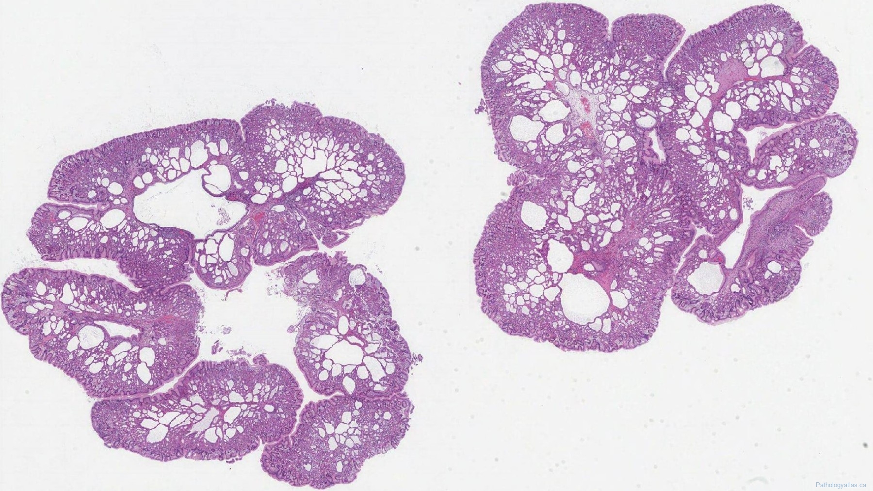 Fundic Gland Polyp Of The Stomach Atlas Of Pathology